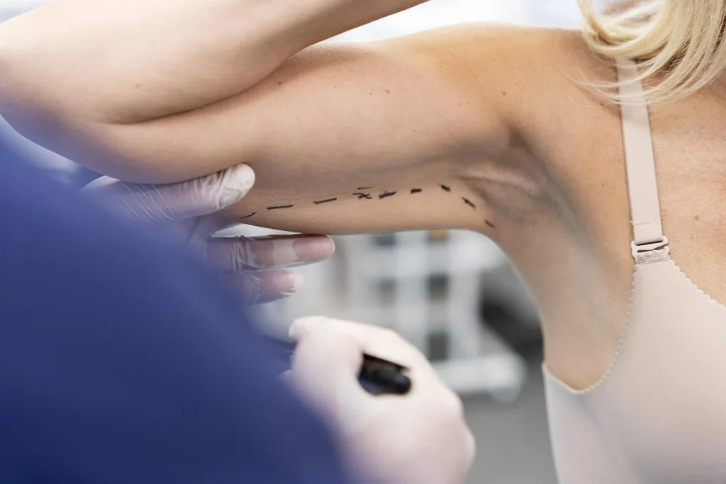 Arm Lift Recovery Timeline: Healing Stages and Tips for Faster Recovery Banner