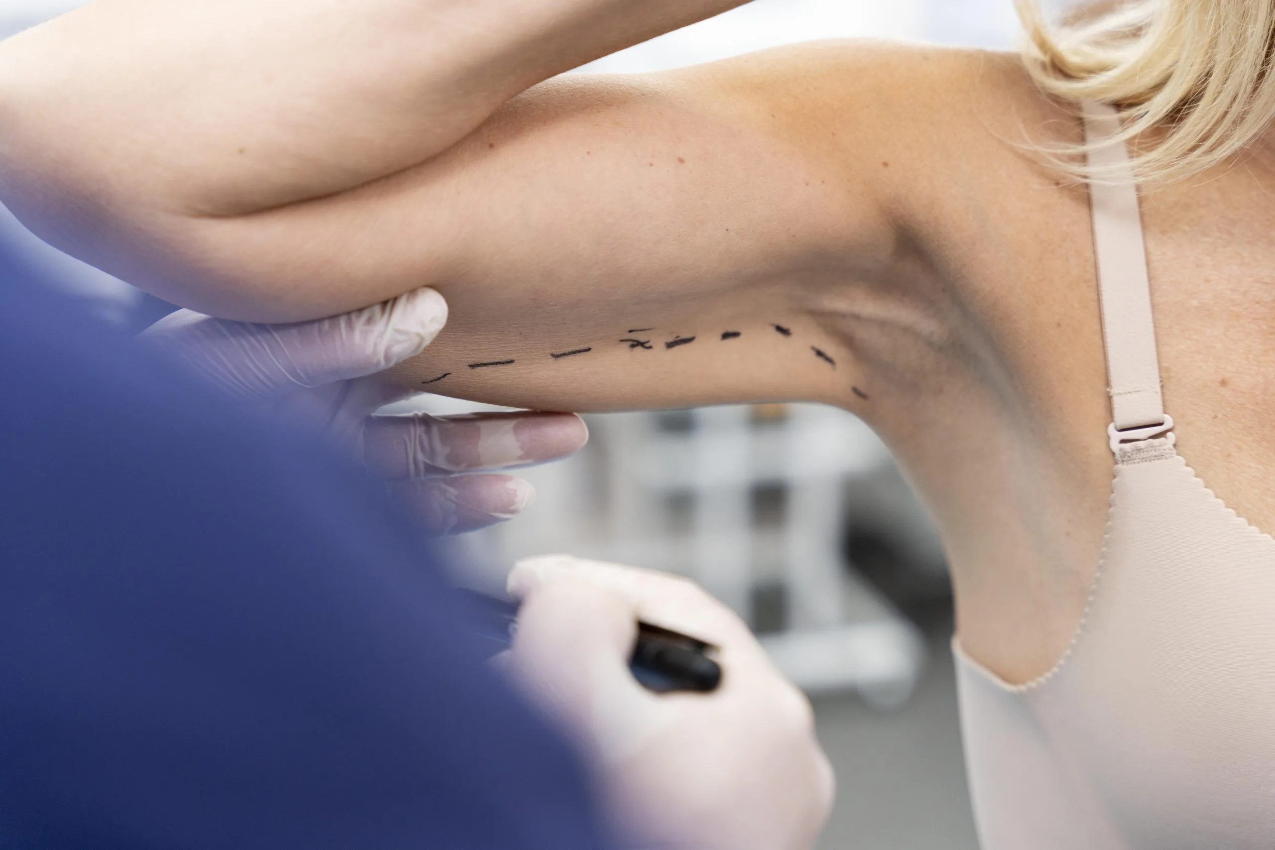 Arm Lift Recovery Timeline: Healing Stages and Tips for Faster Recovery Banner