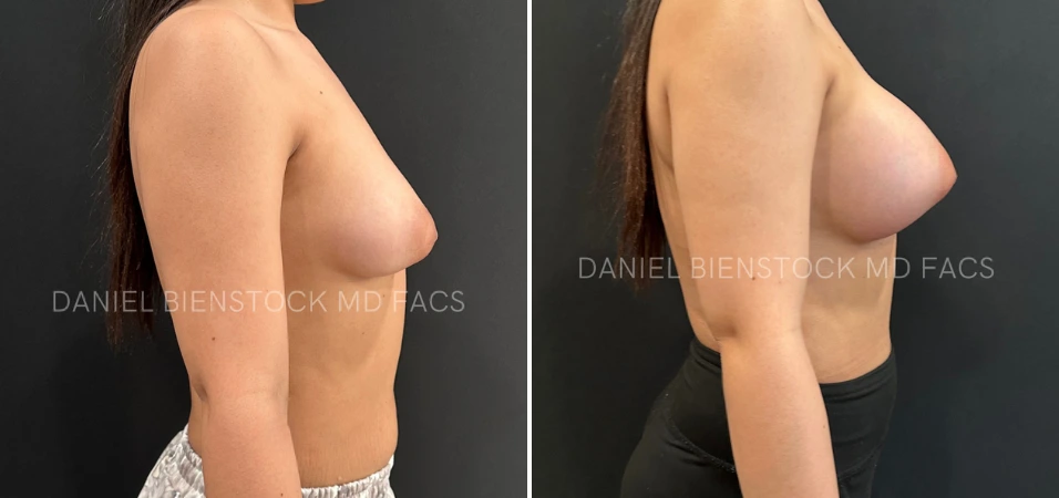 Before and after breast augmentation, side view