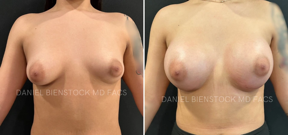 Before and after breast augmentation, front view