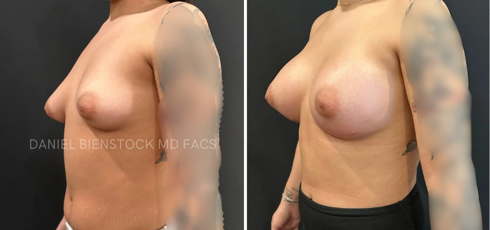 Before and after breast augmentation, oblique view