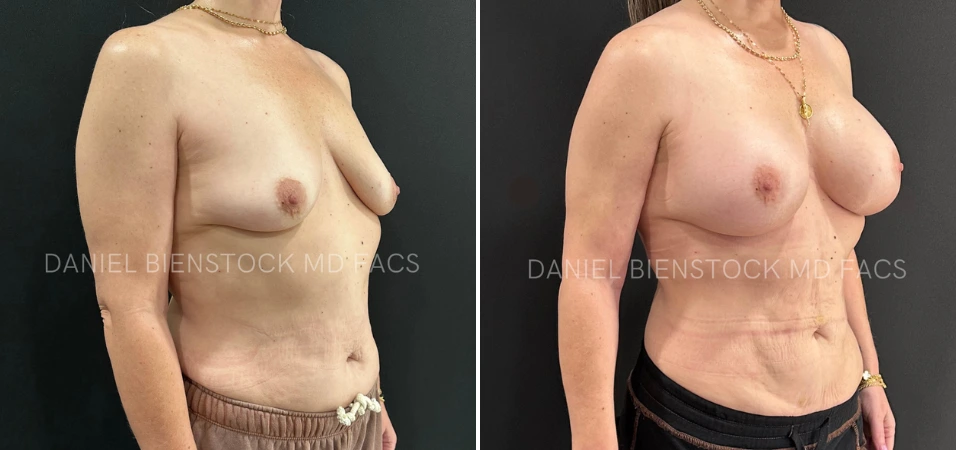 Before and after breast augmentation, side view