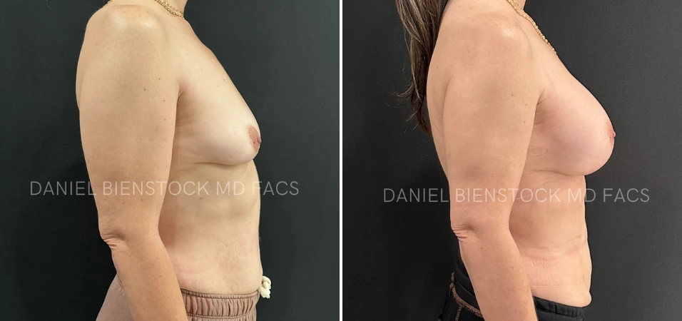 Before and after breast augmentation, side view
