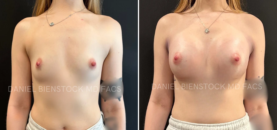 Before and after breast augmentation, frontal view showing increased size and definition