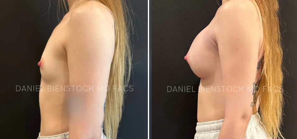 Before and after breast augmentation, side profile view with long hair visible