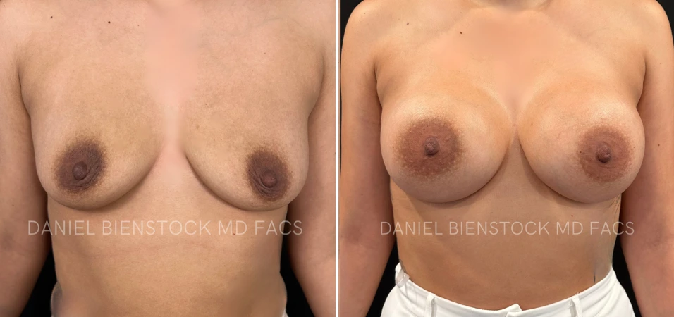 Before and after breast augmentation, front view