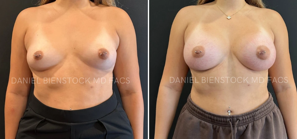 Before and after breast augmentation results showing frontal view comparison