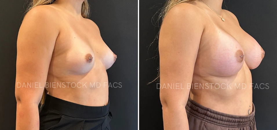 Before and after breast augmentation profile view showing natural-looking volume enhancement