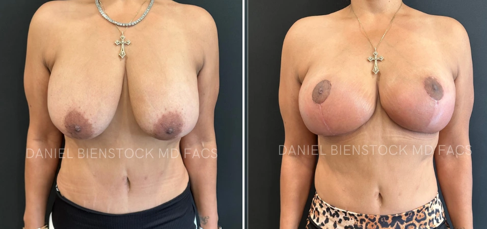 Before and after breast augmentation frontal view demonstrating reduced sagging and enhanced fullness