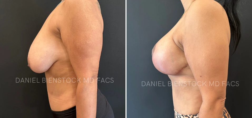 Before and after breast augmentation profile view showing improved contour and symmetry