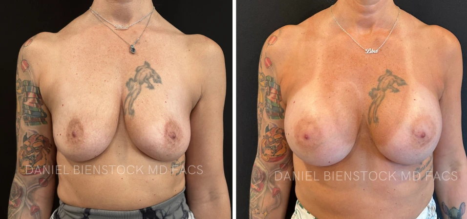 Before and after breast augmentation frontal view with patient tattoos visible on arms