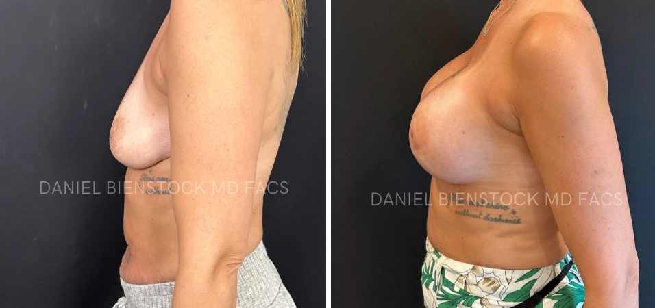 Before and after breast augmentation profile view showing enhanced projection and shape