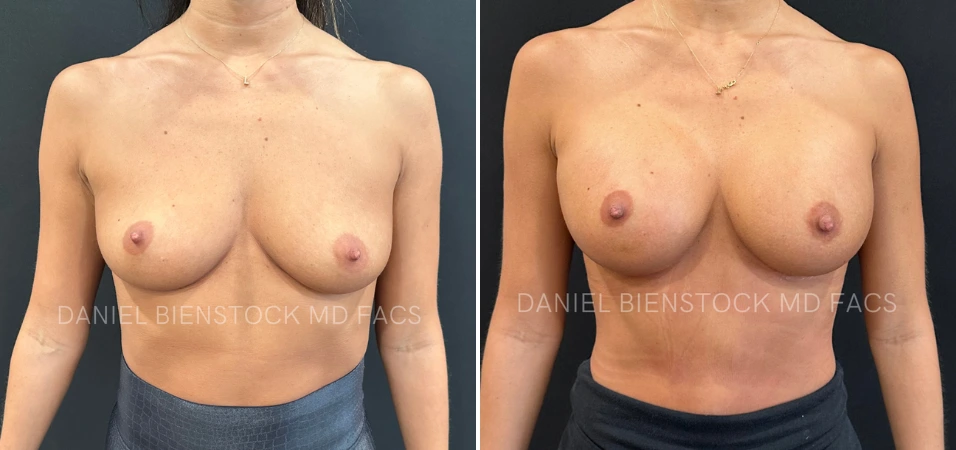 Before and after breast augmentation frontal view showing increased volume and lift