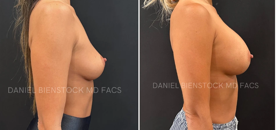 Before and after breast augmentation, side view