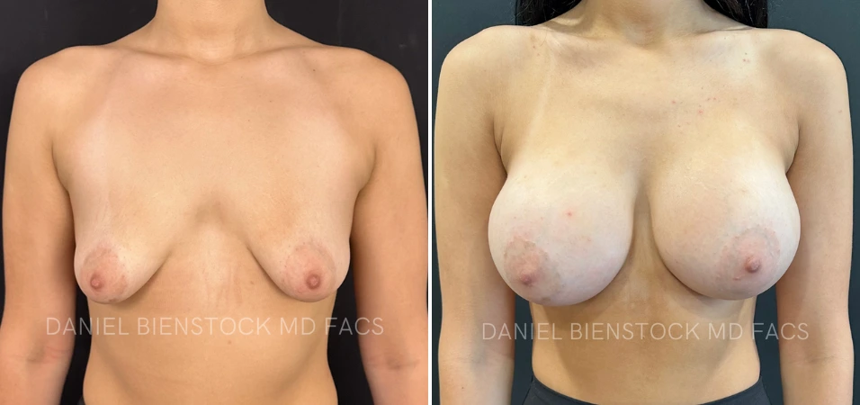 Before and after breast augmentation, front view