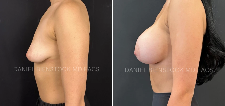 Before and after breast augmentation, side profile view