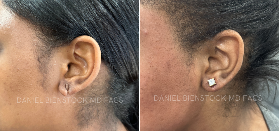 Earlobe 1