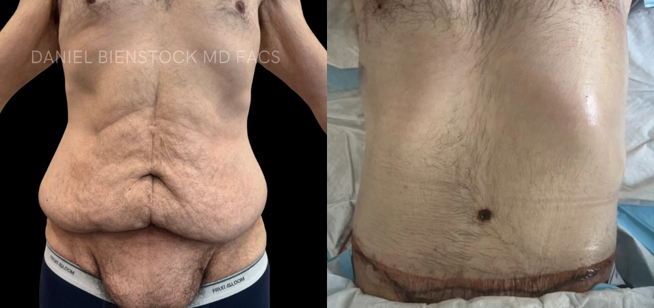 Full body lift before and after comparison showing front and side torso results