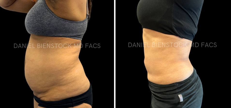 Lipo 26 (2)