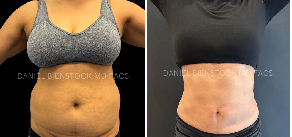 Lipo 26