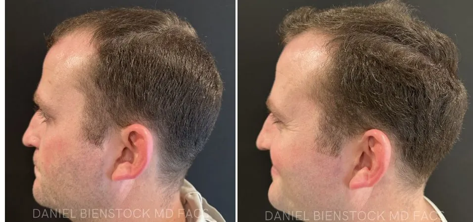 Male patient profile before and after PRP hair treatment showing improved hair density and coverage