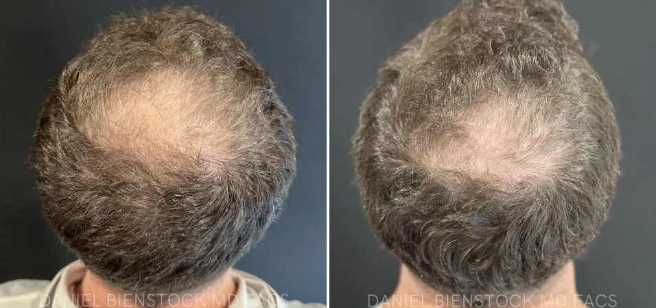 Before and after overhead view showing hair restoration with PRP treatment