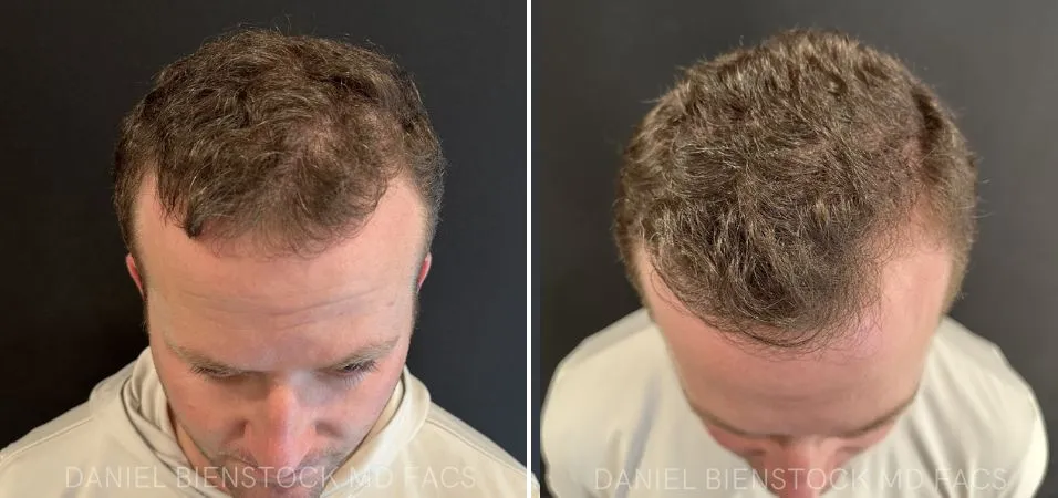 Before and after overhead view showing hair restoration with PRP treatment