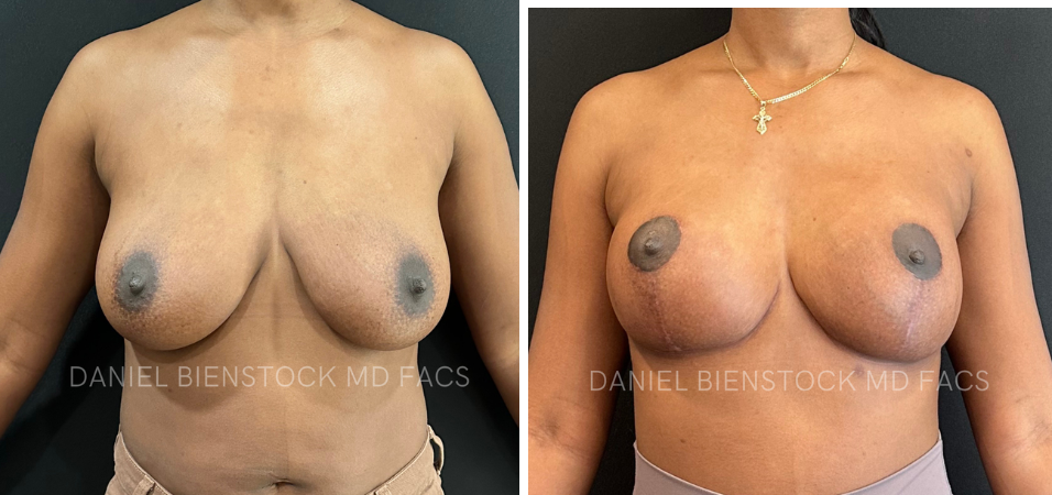 Breast Lift-1-2 (3)