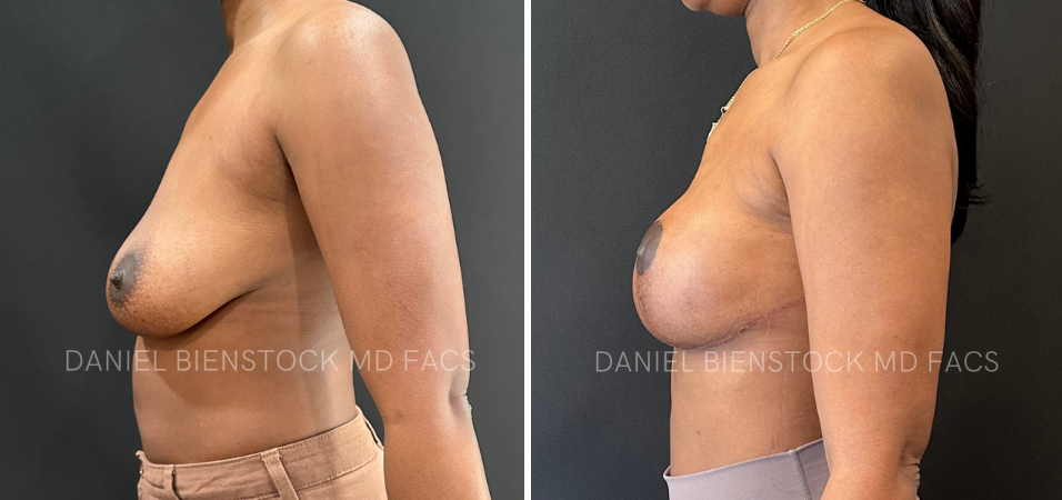 Breast Lift-1-2