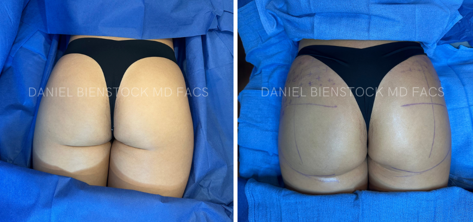 Buttocks Augmentation - 1 - 1