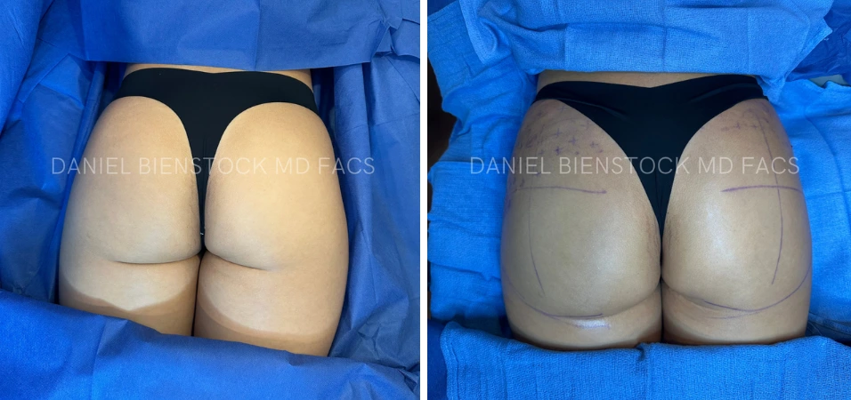 Before and after buttocks augmentation, rear view showing increased volume and projection