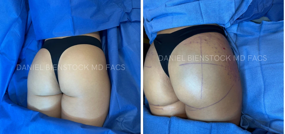 Before and after rear views of buttocks augmentation showing increased fullness and contour