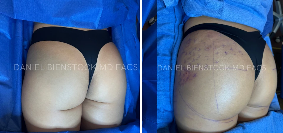 Before and after rear views of buttocks augmentation showing enhanced volume and projection