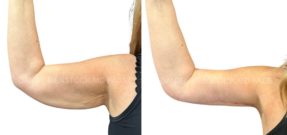 Arm lift before and after showing upper arm contour improvement from two angles