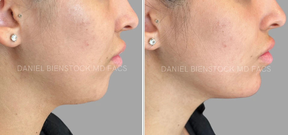 Before and after chin filler results showing enhanced chin projection in profile view