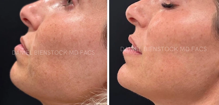 Before and after chin filler profile views showing enhanced chin projection and definition