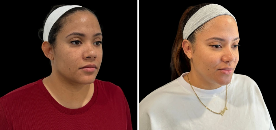 Before and after three-quarter views showing results of ear surgery procedure