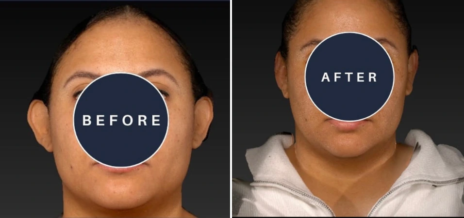 Before and after front-facing views of ear surgery with reduced ear protrusion