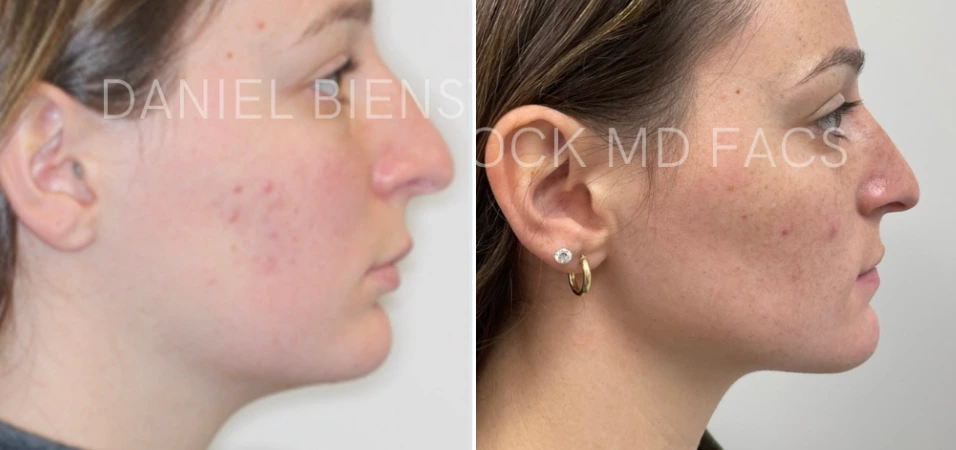 Before and after profile views demonstrating genioplasty results with enhanced chin definition