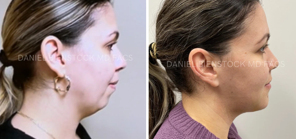 Before and after profile views showing genioplasty case with improved chin contour