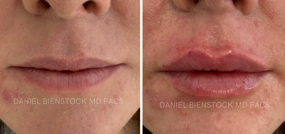 Before and after lip filler results showing fuller, more defined lips