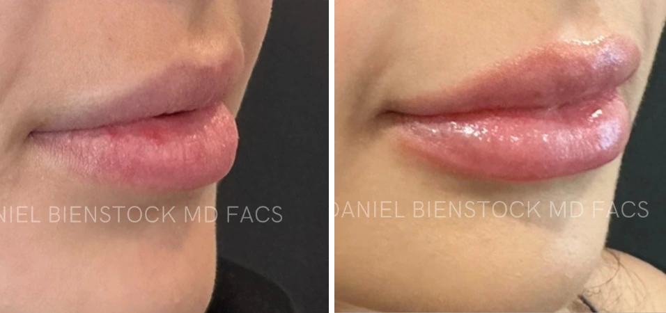 Before and after lip filler case showing increased lip volume and fullness