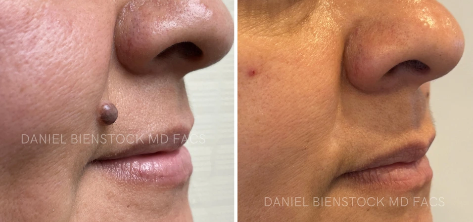 Before and after close-up profile views showing mole removal from chin area