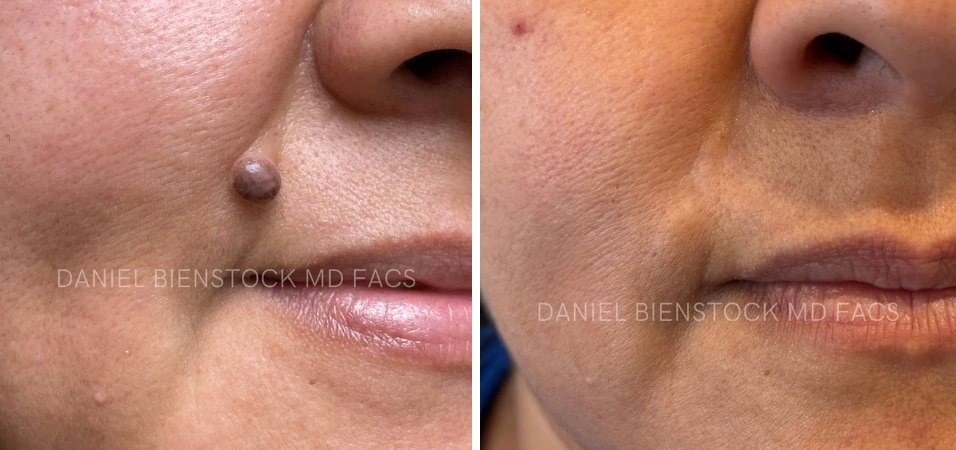 Before and after mole removal from cheek area near nose