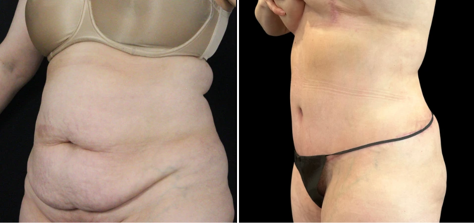 Before and after tummy tuck showing torso and abdominal tightening
