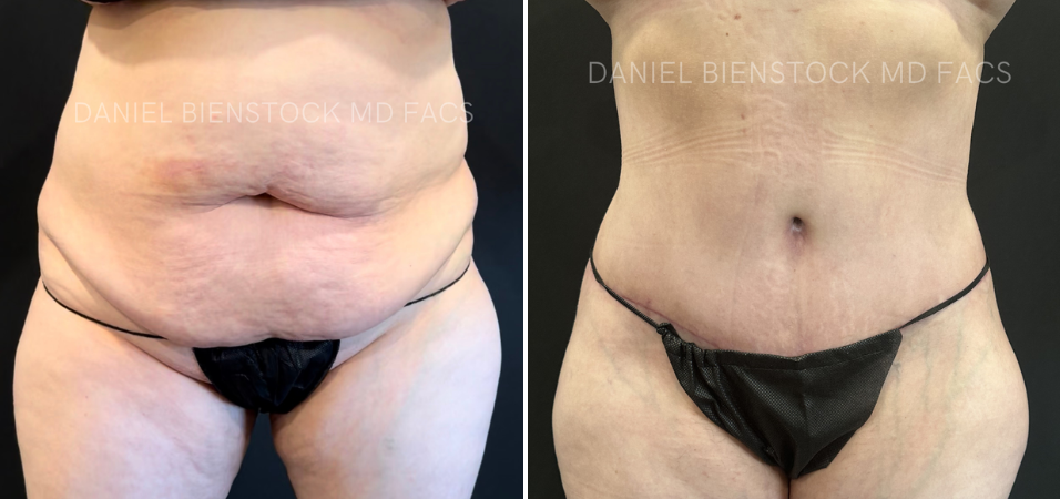 Tummy Tuck-5-3