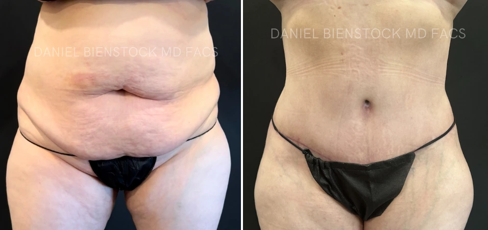 Before and after tummy tuck showing abdominal contour improvement