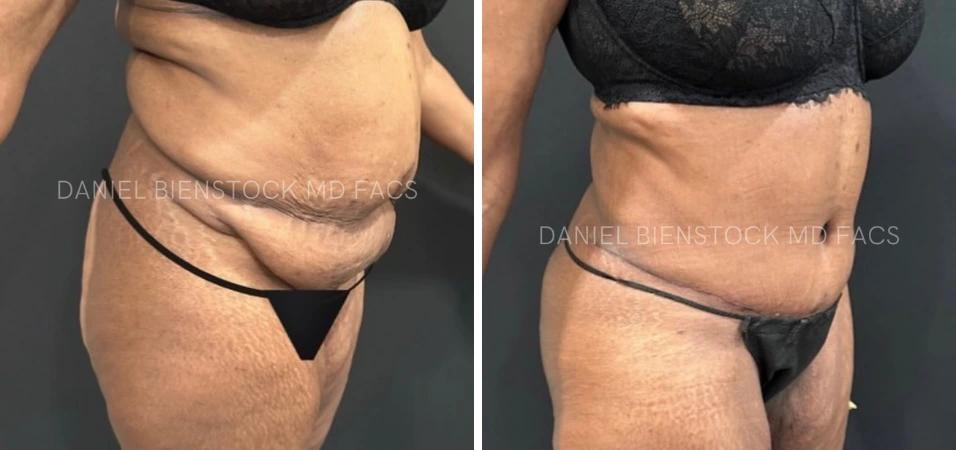 Before and after tummy tuck showing side profile abdominal improvement