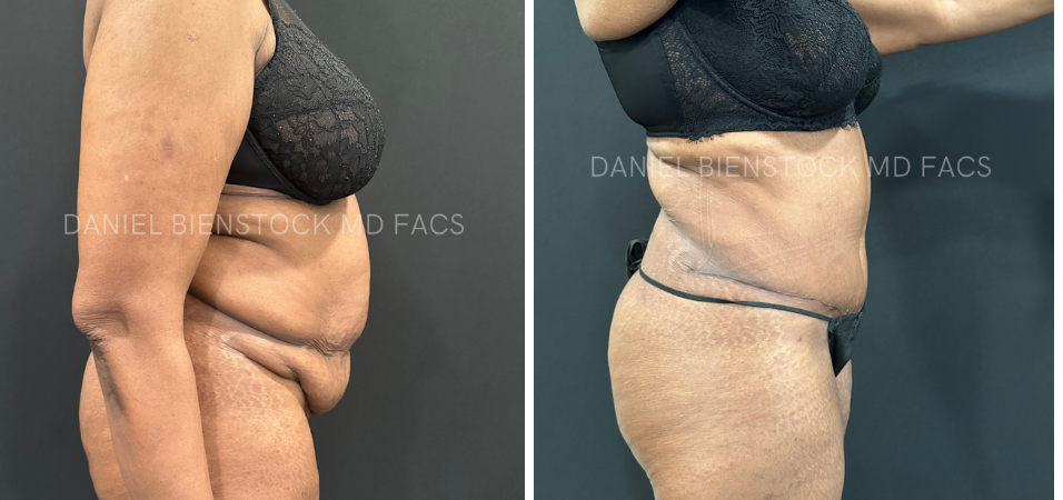 Tummy Tuck-6-2