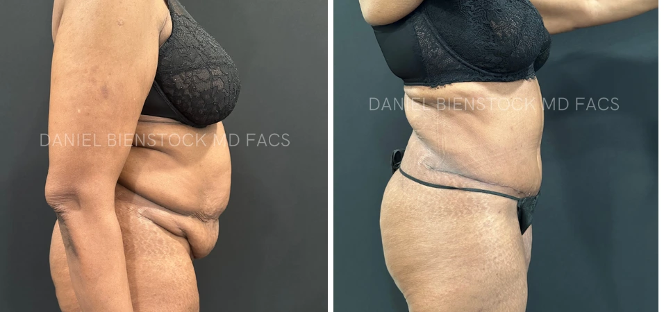 Before and after tummy tuck results showing side profile comparison of abdominal contour